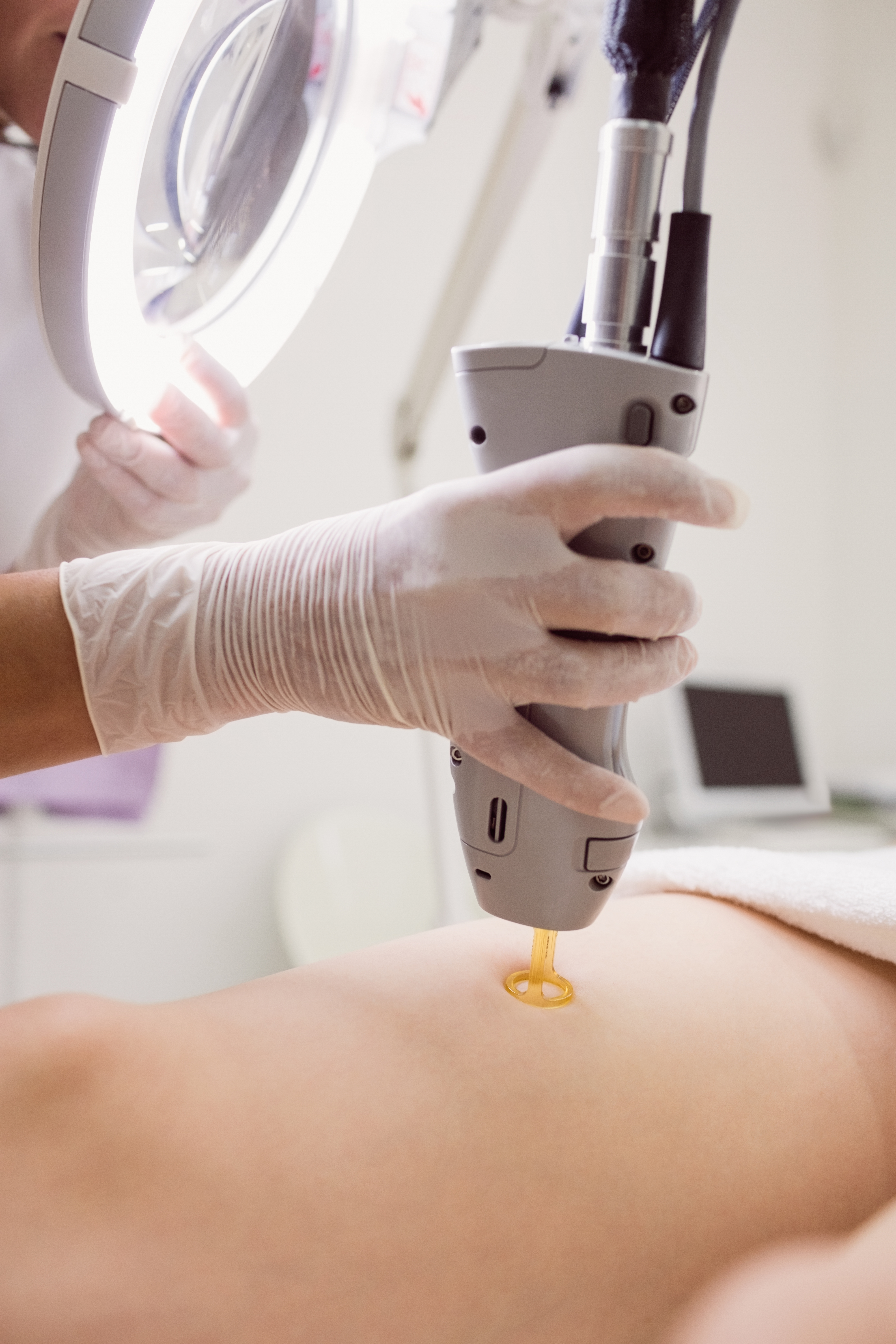 Laser Hair Removal